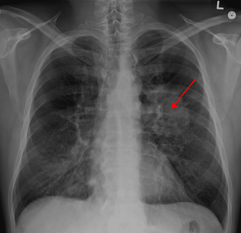 Cáncer de pulmón: los síntomas para detectar el cáncer más letal 3