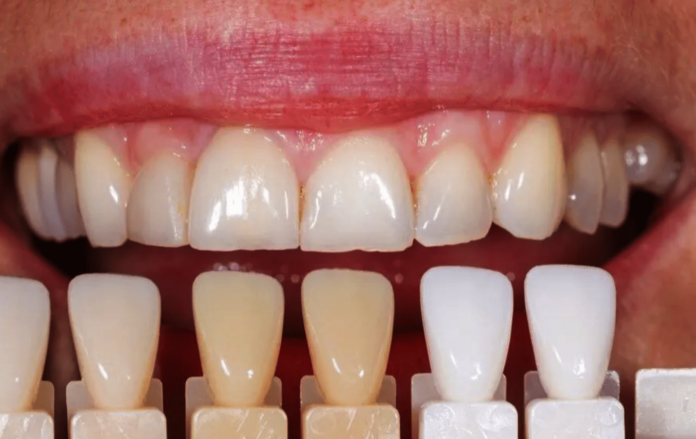 El 40% de la población se acompleja de su sonrisa por no poder blanquearse los dientes