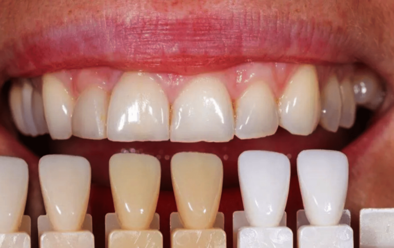 El 40% de la población se acompleja de su sonrisa por no poder blanquearse los dientes