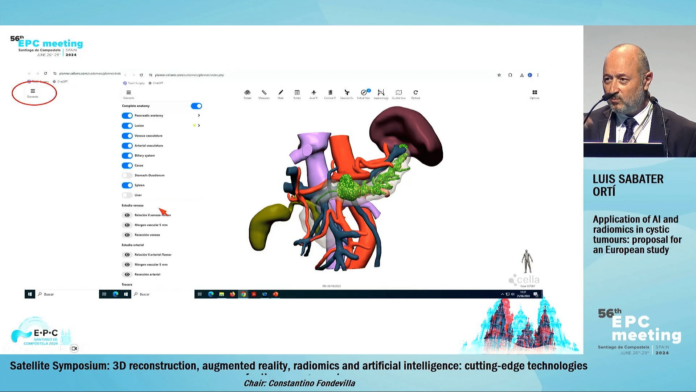 La IA aplicada a modelos 3D podría predecir qué tumores de páncreas derivarán en malignos, según expertos