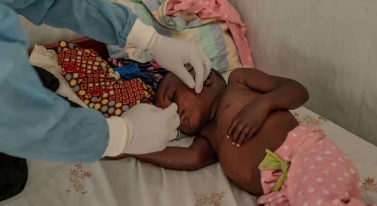 El brote de mpox aumenta la alarma entre los más vulnerables en África oriental y meridional