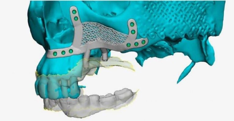 El Dr. Montesdeoca reconstruye el hueso maxilar superior gracias a unos implantes dentales subperiósticos