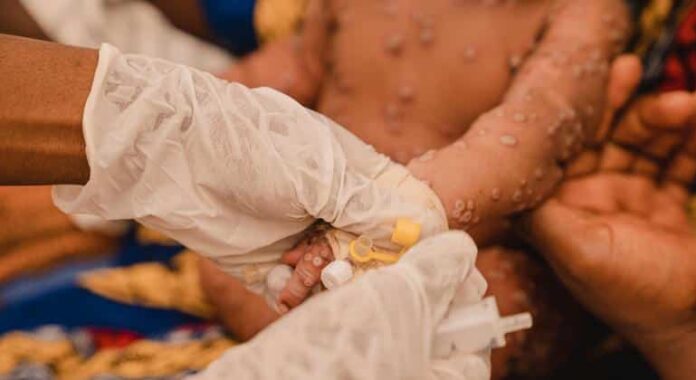 ¿Los más amenazados por el brote de mpox? Los refugiados y desplazados