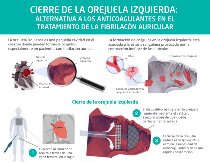 "El cierre de orejuela es una alternativa eficaz para pacientes con fibrilación auricular que no pueden tomar anticoagulantes", doctor José Ramón Rumoroso, jefe de Cardiología del Hospital Quirónsalud Bizkaia