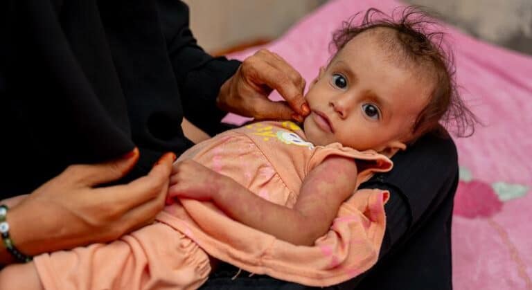 Yemen: Uno de cada dos niños está gravemente desnutrido tras 10 años de guerra