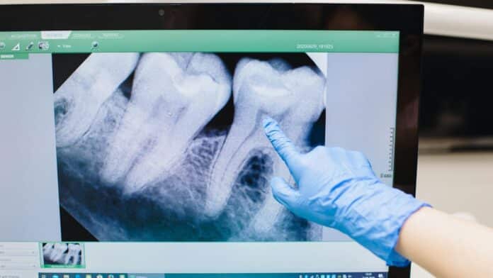 "Cada vez hay más evidencia de que la enfermedad periodontal, una inflamación crónica de las encías, puede estar relacionada con un mayor riesgo de sufrir infartos o accidentes cardiovasculares", doctor Carlos Mederos