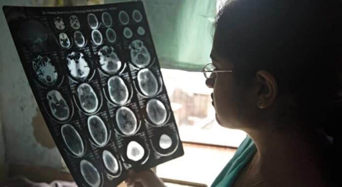 Más de once millones de personas mueren cada año por trastornos neurológicos