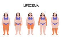 Lipedema: Dolor, Hinchazón y Dificultades en la Marcha en la Vida de las Mujeres Dolor, hinchazón y dificultad para caminar: así impacta el lipedema en la vida de las mujeres
