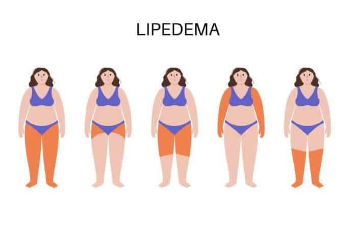 Dolor, hinchazón y dificultad para caminar: así impacta el lipedema en la vida de las mujeres