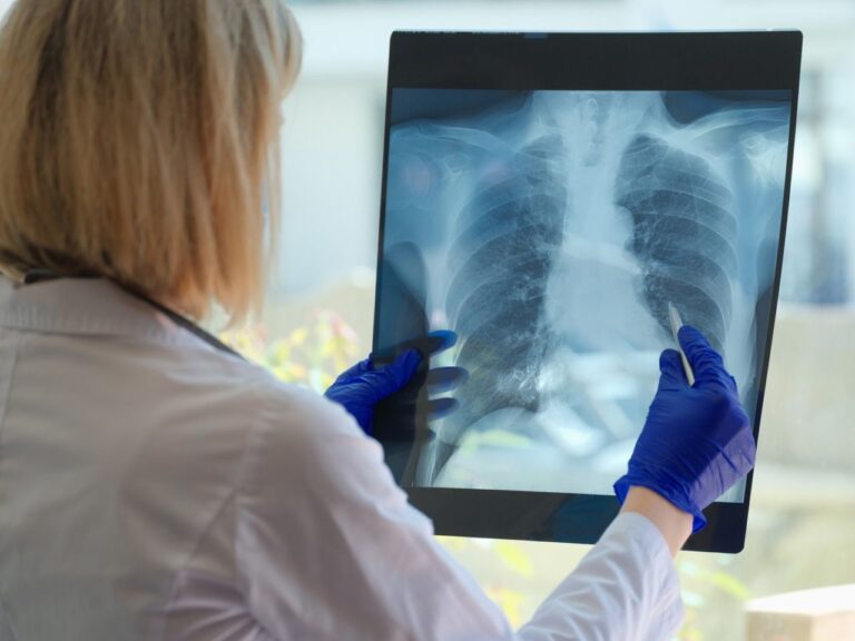 Dr. Aitor Asensi, neumológo de Policlínica Gipuzkoa: "Dejar de fumar es la medida más importante para frenar la evolución de la EPOC"