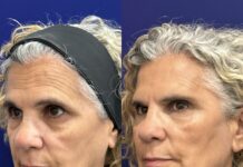 Global Face: El Innovador Protocolo del Dr. Ángel Martín para Revitalizar la Firmeza y Elasticidad Facial Global Face: nuevo protocolo integral del Dr. Ángel Martín para la recuperación de estructuras faciales, de la firmeza y elasticidad dérmica