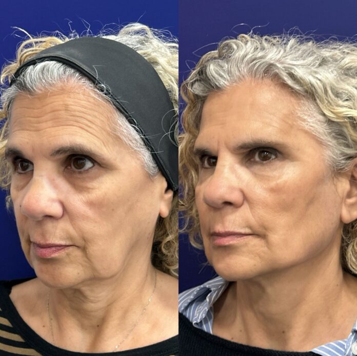 Global Face: El Innovador Protocolo del Dr. Ángel Martín para Global Face: nuevo protocolo integral del Dr. Ángel Martín para la recuperación de estructuras faciales, de la firmeza y elasticidad dérmica