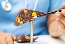 La Pérdida de Peso: Clave para Mejorar el Hígado Graso y el Síndrome Metabólico Dr. Juan Arenas, especialista en Aparato Digestivo de Policlínica Gipuzkoa: "La pérdida de peso es la clave para mejorar el hígado graso y el síndrome metabólico"