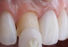 Institut Volpe Lanza Skin Finea®: Carillas Ultrafinas que Conservan el Diente Natural al 100% Instituto Volpe presenta Skin Finea®, carillas ultrafinas que preservan el diente propio al 100%