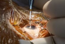 El Codirector de FacoElche se Sometió en Directo a la Implantación Bilateral de una Lente Diseñada con IA El codirector de FacoElche se somete en directo a la implantación bilateral de una lente diseñada con IA