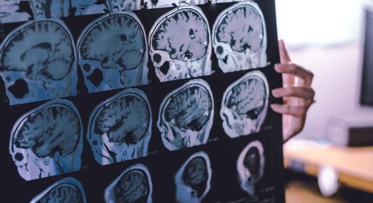 Dos de cada cinco personas en las Américas viven con un trastorno neurológico